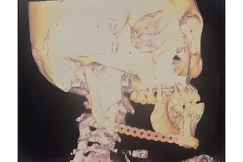 Ilustración digital de un cráneo humano en tonos claros sobre un fondo oscuro, mostrando una placa de reconstrucción metálica unida a la mandíbula inferior