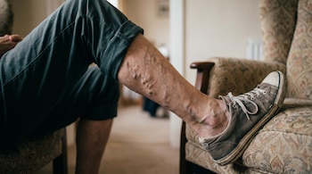 Primer plano de una pierna con venas varicosas abultadas. La persona usa pantalones oscuros enrollados y una zapatilla gris sobre un sillón.