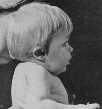 Aspecto del síndrome de Klippel-Feil