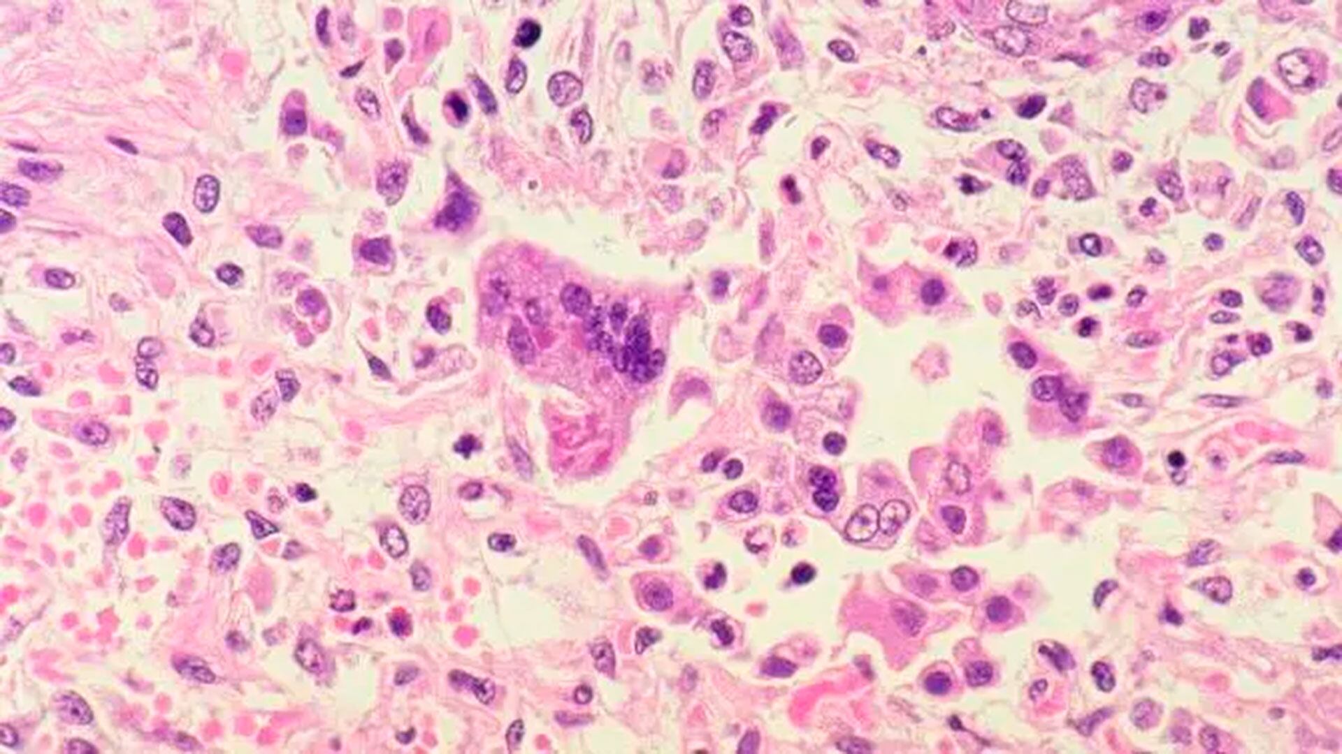 Especialistas advierten que la caída sostenida de la vacunación reabrió la puerta a brotes, un problema que afecta a países de toda la región según la OMS (crédito CDC, EEUU)
