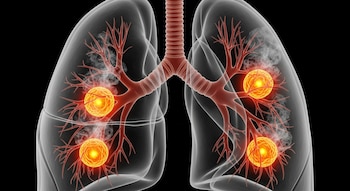 Imagen hiperrealista de pulmones humanos transparentes vistos de frente sobre fondo negro, mostrando bronquios, vasos sanguíneos y tumores naranjas brillantes.