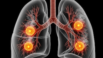 Detectan que el humo de incendios forestales aumenta el riesgo de cinco tipos de cáncer