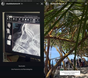 Los exámenes médicos confirmaron que Claudia Bahamón sufrió una fractura y una fisura en la nariz tras el accidente - crédito @claudiabahamon/Instagram