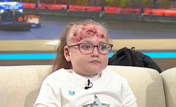 Una niña con anteojos y marcas en la frente permanece sentada en un sofá claro dentro de un estudio de televisión