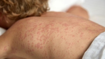 Alerta sanitaria en Argentina: sarampión,