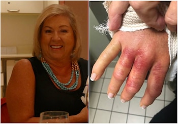 La mujer desarrolló fascitis necrotizante