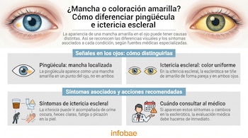 Infografía con ilustraciones de ojos, un ojo con mancha amarilla, otro con esclerótica amarilla, iconos de orina oscura, heces claras, fatiga, picazón, médico y calendario.