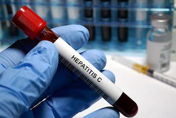 Su médico le dijo que la hepatitis C era una sentencia de muerte y que le quedaban unos 10 años de vida (Europa Press)