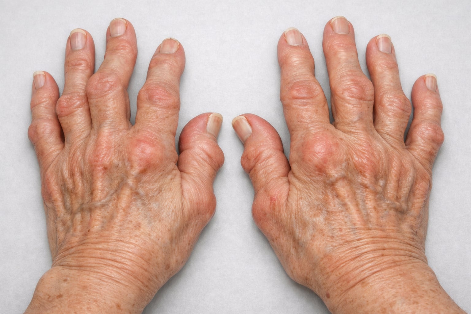 La rigidez matutina prolongada debe generar alerta: si permanece durante 60 minutos o más, especialmente en manos y muñecas, puede corresponder a una artritis inflamatoria (Imagen Ilustrativa Infobae).