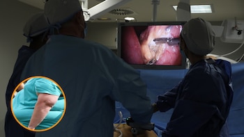 Operación de bypass gástrico.