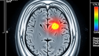 Cómo funciona la innovadora terapia