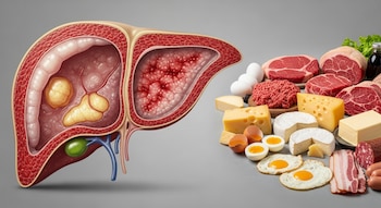 Corte anatómico de hígado con acumulación de grasa e inflamación, junto a carnes, quesos y huevos sobre una mesa.