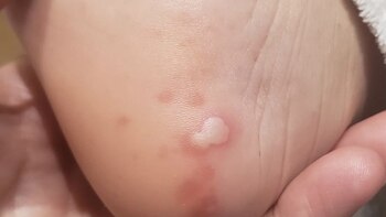 Coronavirus: las cinco manifestaciones del