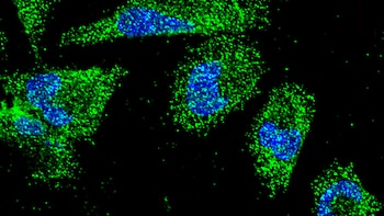 Científicos del CONICET identificaron un mecanismo que podría favorecer la resistencia del cáncer de páncreas