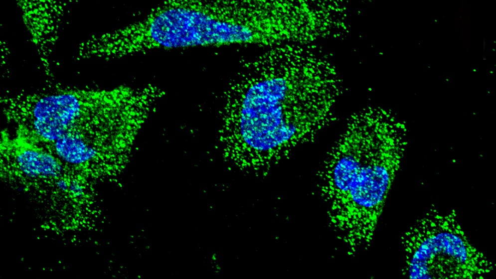 El adenocarcinoma ductal pancreático es el tipo más frecuente de cáncer de páncreas, y su baja supervivencia exige nuevas respuestas científicas (CONICET)