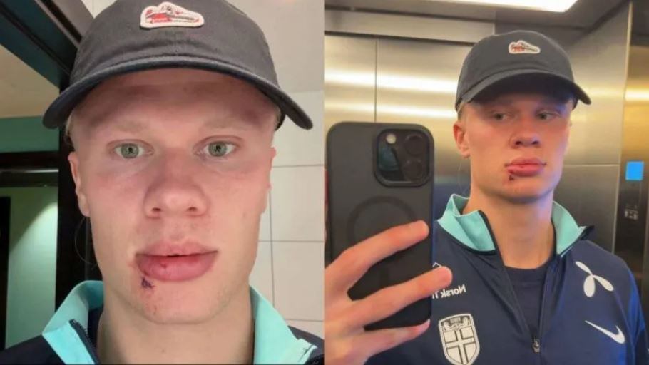 Haaland, con las secuelas del accidente