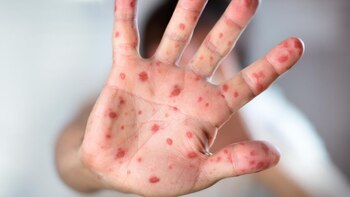 Jalisco ya suma 5 casos