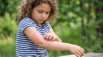 Una niña con cabello rizado y camiseta a rayas azules y blancas se rasca el antebrazo izquierdo, que tiene una erupción roja, contra un fondo verde borroso.