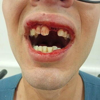 La víctima perdió un diente