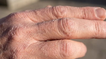Plano detalle del dorso de una mano humana con piel seca y descamada en los dedos y nudillos.