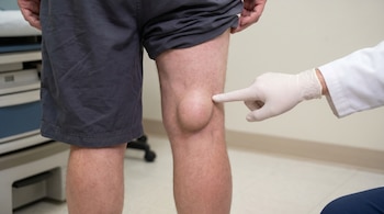 Una persona de pie con pantalones cortos muestra un bulto grande en la parte posterior de la rodilla, mientras una mano enguantada de blanco lo señala.