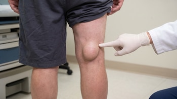 Quiste de Baker, el inesperado bulto detrás de la rodilla: cuándo puede ser una señal de alerta para la salud articular
