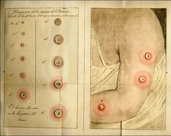 Las pústulas que producía la