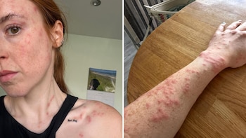 Una influencer sufrió un ataque de chinches en un hotel del Reino Unido