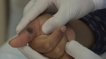 Más de 50.000 casos de viruela del mono fueron registrados desde la aparición del brote de este año, indicó el miércoles la Organización Mundial de la Salud.