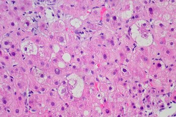 La cirrosis es la sexta