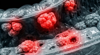 Ilustración realista de un colon que muestra múltiples tumores de color grisáceo y rojizo, con varias áreas iluminadas en rojo, sobre un fondo negro.