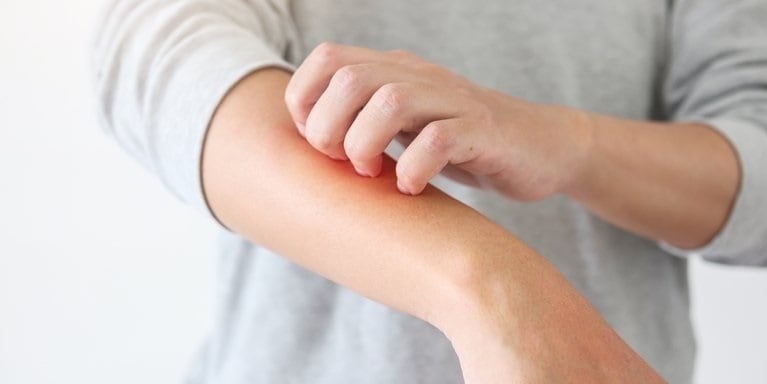 El Día Mundial de la Dermatitis Atópica se conmemora cada 14 de septiembre para visibilizar la importancia del diagnóstico temprano (Hospital Ruber Internacional/Europa Press)