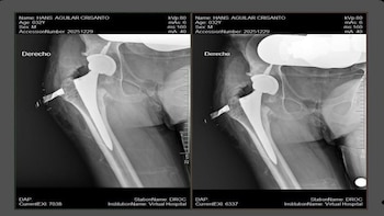 La implementación de este tipo