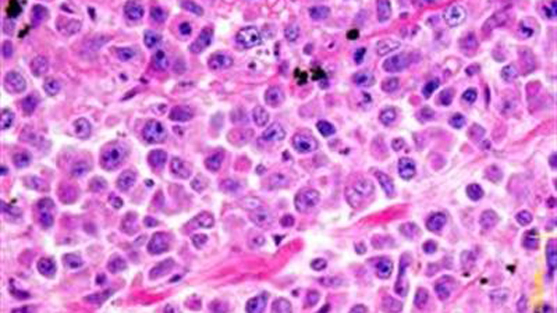 La leucemia mieloide aguda es un cáncer agresivo y letal que puede desarrollarse en cuestión de días y afecta a la sangre y la médula ósea