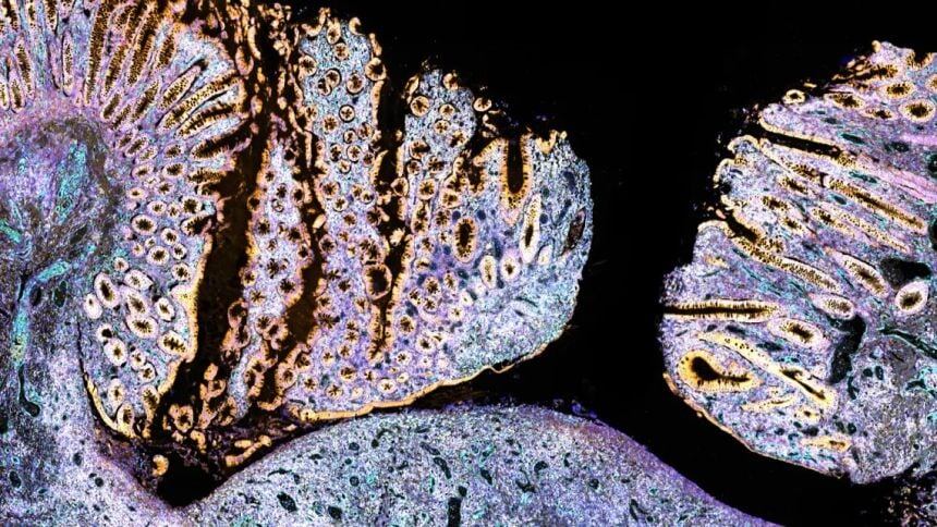 Imagen de transcriptómica espacial que muestra un trayecto fistuloso parcialmente epitelizado; esto significa que algunas partes del túnel han desarrollado un nuevo revestimiento, mientras que otras no. Esto forma parte del proceso de cicatrización desorganizado que se produce en las fístulas de la enfermedad de Crohn. Cada color en la imagen representa un tipo celular diferente (University of Oxford)