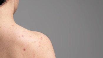 El acné también aparece en