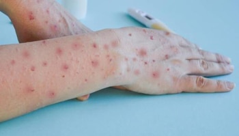 El paciente afectado por el mpox clado Ib permanece en buen estado y bajo monitoreo, sin registrarse casos adicionales ni cadenas de transmisión vinculadas en el país - crédito Academia Nacional de Medicina de Colombia