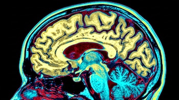 Resonancia magnética de perfil de una cabeza humana que muestra el cerebro en tonos amarillo, azul y rojo sobre un fondo negro.