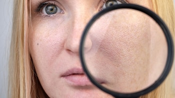 Xavier Batalla, doctor: “Los poros