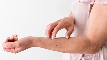 Urticaria por ejercicio