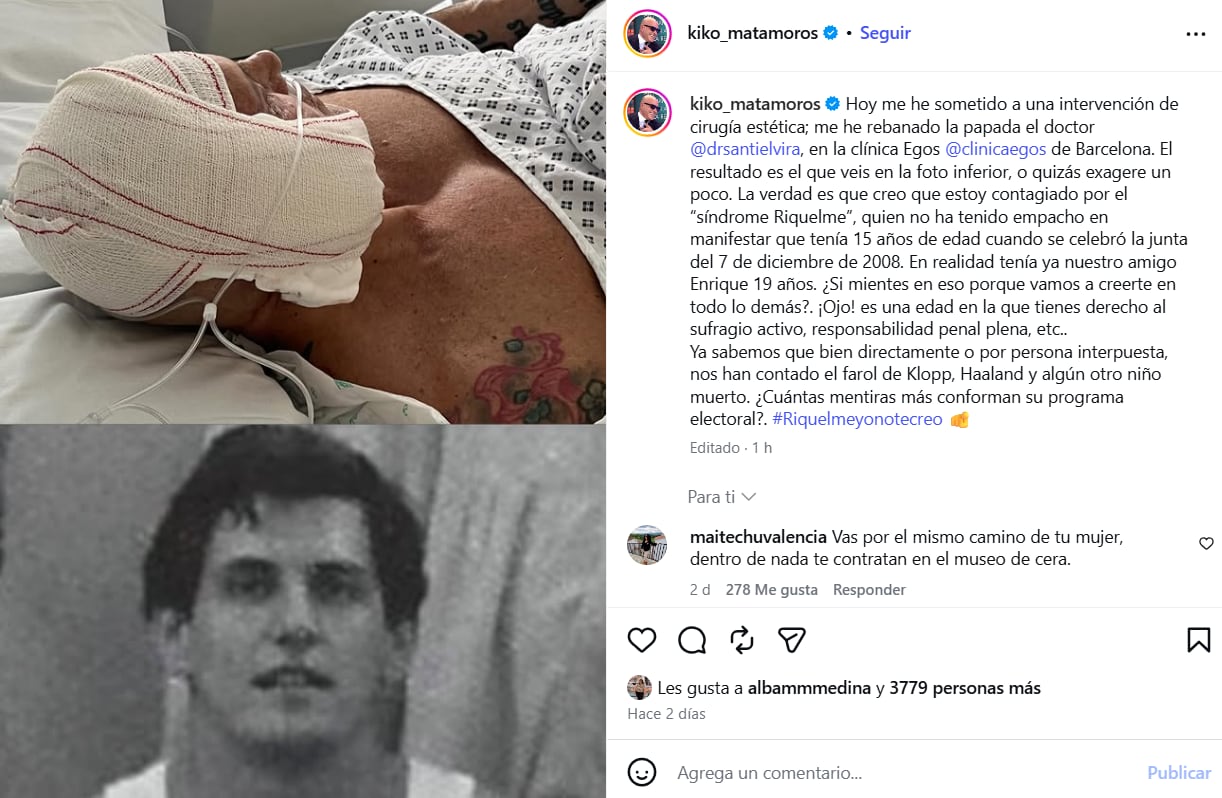 Las sobrecogedoras imágenes de Kiko Matamoros tras una nueva operación estética (Instagram)