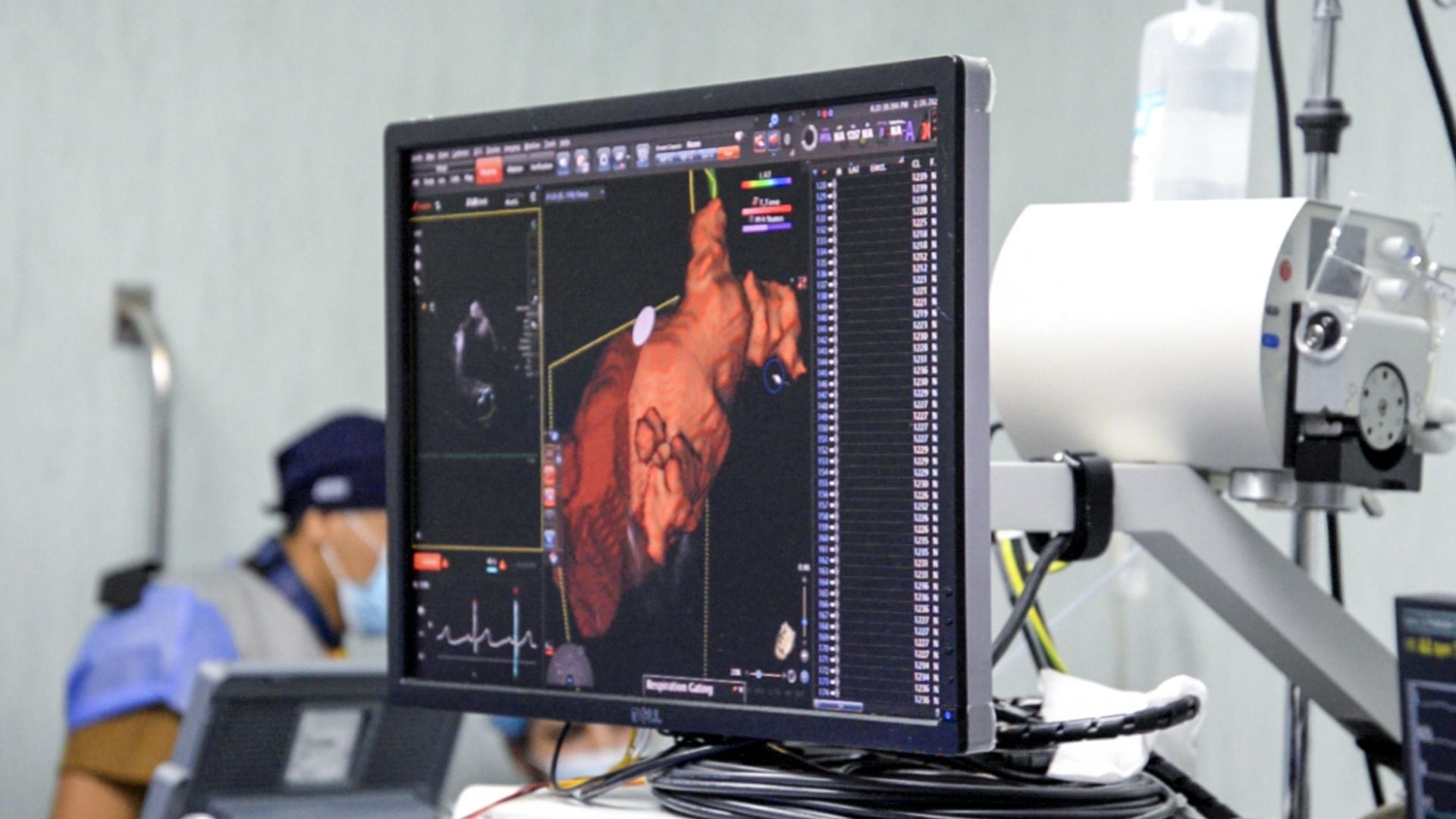 Essalud introduce tecnología de ablación avanzada para arritmias cardíacas en el sistema público peruano - Créditos: INCOR.