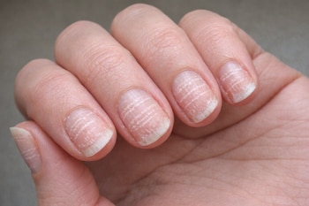 Primer plano de una mano con los dedos ligeramente flexionados, mostrando uñas con múltiples estrías horizontales blancas en la superficie.