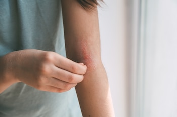 La dermatitis atópica es una