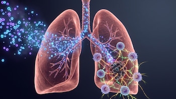 Una inmunoterapia inhalada muestra resultados alentadores contra el cáncer de pulmón avanzado