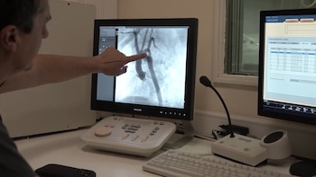 Cirugía inédita: por primera vez, colocaron un stent bioabsorbible en un bebé prematuro