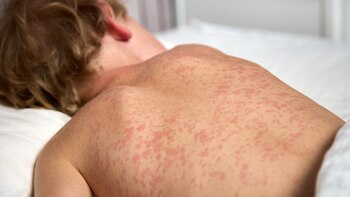 Por qué el sarampión resurge con fuerza en el mundo y qué podemos hacer al respecto