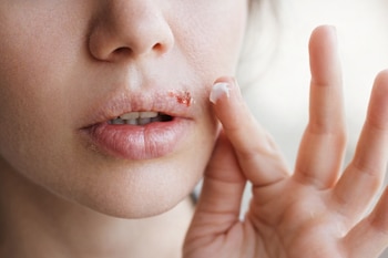 El herpes labial es una