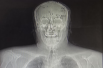 Una radiografía de una persona