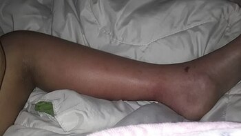 Qué es el Síndrome Inflamatorio